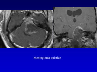 Meningioma quistico