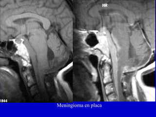 Meningioma en placa