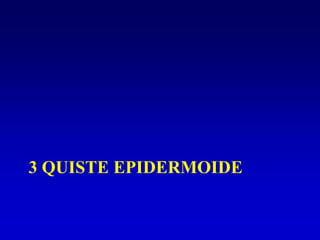 3 QUISTE EPIDERMOIDE