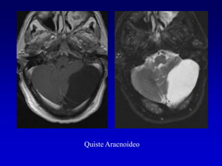 Quiste Aracnoideo