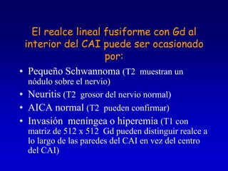 El realce lineal fusiforme con Gd al interior del CAI puede ser ocasionado por:Pequeño Schwannoma (T2  muestran un nódulo sobre el nervio)Neuritis (T2  grosor del nervio normal)AICA normal (T2  pueden confirmar)Invasión  meníngea o hiperemia (T1 con matriz de 512 x 512  Gd pueden distinguir realce a lo largo de las paredes del CAI en vez del centro del CAI)