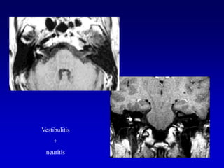 Vestibulitis+neuritis
