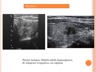 TIRADS 5
Patrón maligno: Nódulo sólido hipoecogénico,
de márgenes irregulares, sin cápsula
 