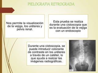 PIELOGRAFIA RETROGRADA
Nos permite la visualización
de la vejiga, los uréteres y
pelvis renal.
Esta prueba se realiza
durante una cistoscopia que
es la evaluación de la vejiga
con un endoscopio
Durante una cistoscopia, se
puede introducir colorante
de contraste en los uréteres
a través de un catéter, lo
que ayuda a realzar las
imágenes radiográficas.
 