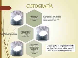 La cistografía es un procedimiento
de diagnóstico que utiliza rayos-X
para examinar la vejiga urinaria.
Se inyecta un
colorante de
contraste en la
vejiga
Se toman rayos-X de la vejiga y se
puede utilizar la fluoroscopia para
estudiar el vaciado de la vejiga
mientras la persona orina
Puede indicar si la
vejiga se vacía
bien al orinar, y si
hay reflujo
vesicouretral
La cistografía se puede realizar
a evaluar la causa de hematuria
La cistografía
también se puede
usar para evaluar
problemas de
vaciado de la
vejiga e
incontinencia
urinaria
 