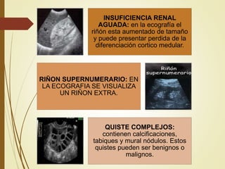 INSUFICIENCIA RENAL
AGUADA: en la ecografía el
riñón esta aumentado de tamaño
y puede presentar perdida de la
diferenciación cortico medular.
RIÑON SUPERNUMERARIO: EN
LA ECOGRAFIA SE VISUALIZA
UN RIÑON EXTRA.
QUISTE COMPLEJOS:
contienen calcificaciones,
tabiques y mural nódulos. Estos
quistes pueden ser benignos o
malignos.
 