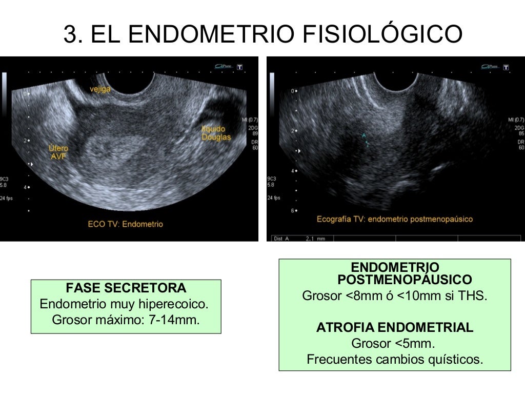 Estudio radiológico del endometrio. Lola Fernández de la Fuente Bursón Estudio radiológico del endometrio. Lola Fernández de la Fuente Bursón