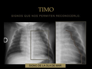 estudio-radiologico-del-torax-en-pediatria-septiembre-2015-ag-2016-hgsj