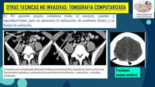 OTRAS TÉCNICAS NO INVASIVAS: TOMOGRAFÍA COMPUTARIZADA
Trombosis
venosa cerebral
 