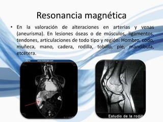 Resonancia magnética
• En la valoración de alteraciones en arterias y venas
(aneurisma). En lesiones óseas o de músculos, ligamentos,
tendones, articulaciones de todo tipo y región: Hombro, codo,
muñeca, mano, cadera, rodilla, tobillo, pie, mandíbula,
etcétera.
 