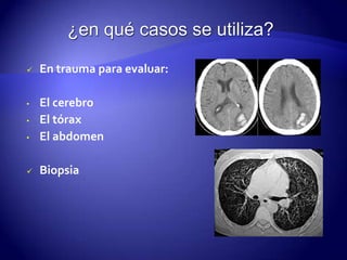  En trauma para evaluar:
• El cerebro
• El tórax
• El abdomen
 Biopsia
 