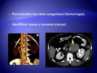  Para estudiar los vasos sanguíneos (hemorragia).
 Identificar masas y tumores (cáncer)
 