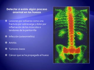  Lesiones por esfuerzo como una
fractura por sobrecarga y dolor por
inflamación de los músculos o
tendones de la pantorrilla
 Infección (osteomielitis)
 Artritis
 Tumores óseos
 Cáncer que se ha propagado al hueso
Detectar si existe algún proceso
anormal en los huesos
 