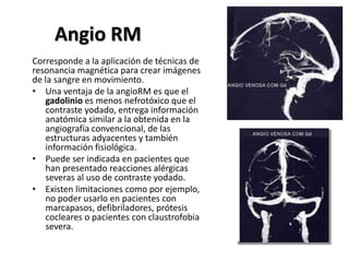 Angio RM
Corresponde a la aplicación de técnicas de
resonancia magnética para crear imágenes
de la sangre en movimiento.
• Una ventaja de la angioRM es que el
gadolinio es menos nefrotóxico que el
contraste yodado, entrega información
anatómica similar a la obtenida en la
angiografía convencional, de las
estructuras adyacentes y también
información fisiológica.
• Puede ser indicada en pacientes que
han presentado reacciones alérgicas
severas al uso de contraste yodado.
• Existen limitaciones como por ejemplo,
no poder usarlo en pacientes con
marcapasos, defibriladores, prótesis
cocleares o pacientes con claustrofobia
severa.
 