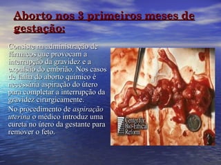 Aborto nos 3 primeiros meses de gestação: Consiste na administração de fármacos que provocam a interrupção da gravidez e a expulsão do embrião. Nos casos de falha do aborto químico é necessária aspiração do útero para completar a interrupção da gravidez cirurgicamente.  No procedimento de  aspiração uterina  o médico introduz uma cureta no útero da gestante para remover o feto.  