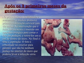 Após os 3 primeiros meses da gestação: No procedimento de  dilatação e evacuação,  o médico promove primeiro a dilatação cervical (um dia antes). Na intervenção que é feita sob anestesia é inserido um aparelho cirúrgico para cortar o feto em pedaços, e retirá-los um a um de dentro do útero. No final é feita a aspiração. O feto é remontado no exterior para garantir que não há nenhum pedaço no interior do útero que poderia levar a infecção séria.  