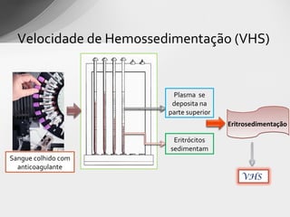 Velocidade de Hemossedimentação (VHS)


                         Plasma se
                         deposita na
                        parte superior
                                         Eritrosedimentação

                         Eritrócitos
                        sedimentam
Sangue colhido com
  anticoagulante
                                             VHS
 