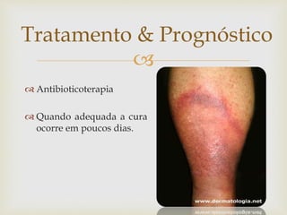 
 Antibioticoterapia
 Quando adequada a cura
ocorre em poucos dias.
Tratamento & Prognóstico
 