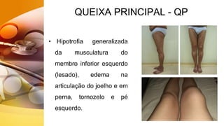 QUEIXA PRINCIPAL - QP
• Hipotrofia generalizada
da musculatura do
membro inferior esquerdo
(lesado), edema na
articulação do joelho e em
perna, tornozelo e pé
esquerdo.
 
