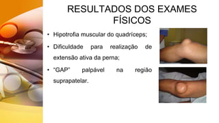RESULTADOS DOS EXAMES
FÍSICOS
• Hipotrofia muscular do quadríceps;
• Dificuldade para realização de
extensão ativa da perna;
• “GAP” palpável na região
suprapatelar.
 