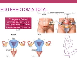 É um procedimento
cirúrgico que envolve a
remoção de todo o útero,
juntamente com o colo do
útero.
HISTERECTOMIATOTAL
 