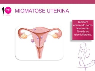 MIOMATOSE UTERINA
Também
conhecido como
leiomioma,
fibróide ou
leiomiofibroma.
 