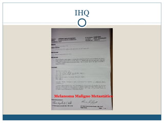 IHQ




Melanoma Maligno Metastático
 
