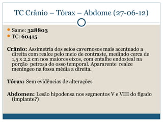 TC Crânio – Tórax – Abdome (27-06-12)

 Same: 328803
 TC: 60415


Crânio: Assimetria dos seios cavernosos mais acentuado a
 direita com realce pelo meio de contraste, medindo cerca de
 1,5 x 2,2 cm nos maiores eixos, com entalhe endosteal na
 porção petrosa do osso temporal. Apararente realce
 meníngeo na fossa média a direita.

Tórax: Sem evidências de alterações

Abdomen: Lesão hipodensa nos segmentos V e VIII do fígado
 (implante?)
 