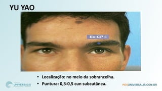 YU YAO
• Localização: no meio da sobrancelha.
• Puntura: 0,3-0,5 cun subcutânea.
 