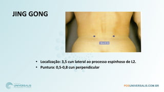 JING GONG
• Localização: 3,5 cun lateral ao processo espinhoso de L2.
• Puntura: 0,5-0,8 cun perpendicular
 