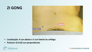 ZI GONG
• Localização: 4 cun abaixo e 3 cun lateral ao umbigo.
• Puntura: 0,5-0,8 cun perpendicular
 