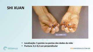 SHI XUAN
• Localização: 5 pontos na pontas dos dedos da mão
• Puntura: 0,1-0,2 cun perpendicular
 