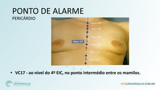 PONTO DE ALARME
PERICÁRDIO
• VC17 - ao nível do 4º EIC, no ponto intermédio entre os mamilos.
 