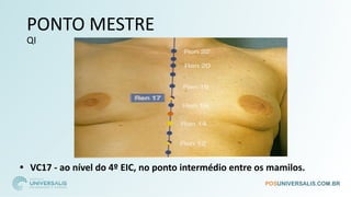 PONTO MESTRE
QI
• VC17 - ao nível do 4º EIC, no ponto intermédio entre os mamilos.
 