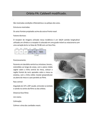Orbita PA: Caldwell modificado.
.

São mostradas condições inflamatórias e os pólipos dos seios.

Estruturas mostradas:

Os seios frontais projetados acima da sutura fronto nasal.

Fatores técnicos:

O receptor de imagens utilizado nessa incidência é um 18x24 sentido longitudinal
utilizado um cilindro e o receptor é colocado em uma grade móvel ou estacionaria com
uma variação de kv na faixa de 70-80 com um foco fino.




Posicionamento:

Paciente em decúbito ventral ou ortostase, bracos ,
estendidos ao longo do corpo, com o plano médio
sagital sobre a linha central da mesa, colocar a
região frontal do nariz apoiados sobre a mesa ou
estativa, com a linha orbito meatal perpendicular
ao plano da mesa e o pvo paralelo ao filme.

Raio central:

Angulado de 15º a 20º caudal, entrando na lambda
e saindo no centro do filme ou das orbitas.

Distancia foco filme:

Um metro.

Colimação:

Colimar a área das cavidades nasais.
 