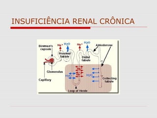 INSUFICIÊNCIA RENAL CRÔNICA
 