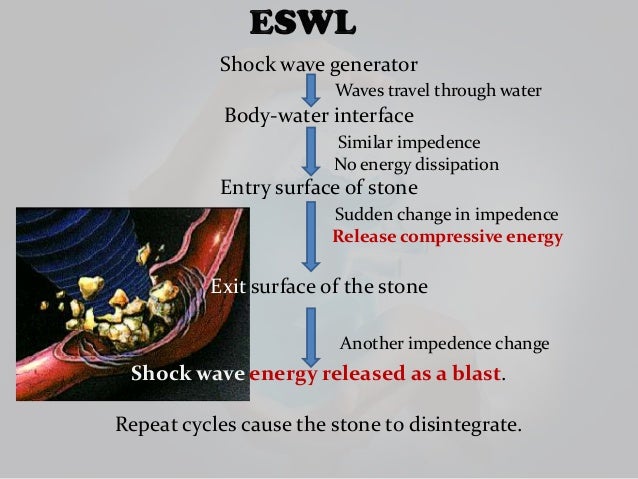 Eswl PCNL MAC Urological procedures - Eswl Pcnl Mac Urological Procedures 9 638 