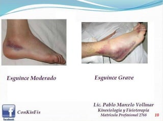 Esguince de Tobillo