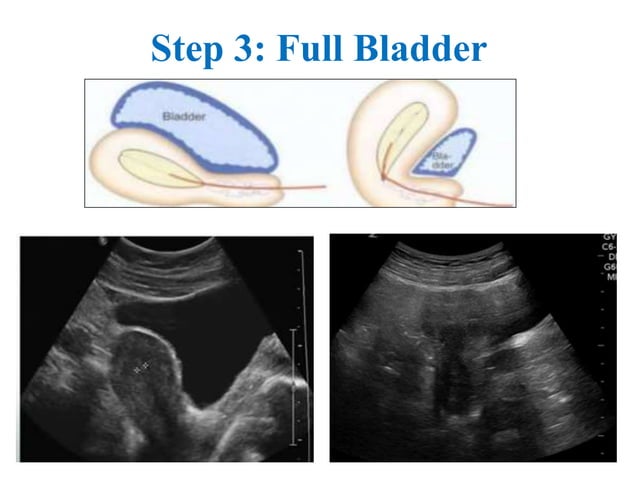 Embryo Transfer | PPTX | Pregnancy | Reproductive Health