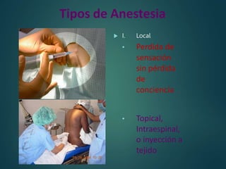 Tipos de Anestesia
 I. Local
• Perdida de
sensación
sin pérdida
de
conciencia
• Topical,
Intraespinal,
o inyección a
teji...
