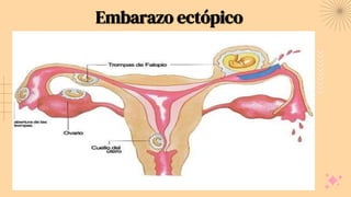 Embarazo ectópico
 