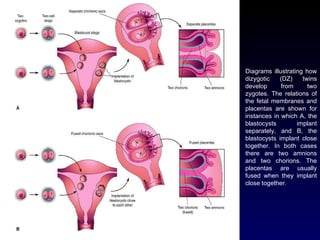 Diagrams illustrating how dizygotic (DZ) twins develop from two zygotes. The relations of the fetal membranes and placentas are shown for instances in which A, the blastocysts implant separately, and B, the blastocysts implant close together. In both cases there are two amnions and two chorions. The placentas are usually fused when they implant close together.  