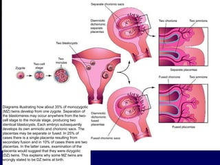Diagrams illustrating how about 35% of monozygotic (MZ) twins develop from one zygote. Separation of the blastomeres may occur anywhere from the two-cell stage to the morula stage, producing two identical blastocysts. Each embryo subsequently develops its own amniotic and chorionic sacs. The placentas may be separate or fused. In 25% of cases there is a single placenta resulting from secondary fusion and in 10% of cases there are two placentas. In the latter cases, examination of the placenta would suggest that they were dizygotic (DZ) twins. This explains why some MZ twins are wrongly stated to be DZ twins at birth.  