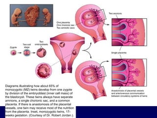 Diagrams illustrating how about 65% of monozygotic (MZ) twins develop from one zygote by division of the embryoblast (inner cell mass) of the blastocyst. These twins always have separate amnions, a single chorionic sac, and a common placenta. If there is anastomosis of the placental vessels, one twin may receive most of the nutrition from the placenta. Inset, monozygotic twins, 17-weeks gestation. (Courtesy of Dr. Robert Jordan.).  