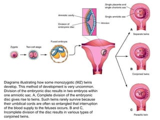 Diagrams illustrating how some monozygotic (MZ) twins develop. This method of development is very uncommon. Division of the embryonic disc results in two embryos within one amniotic sac. A, Complete division of the embryonic disc gives rise to twins. Such twins rarely survive because their umbilical cords are often so entangled that interruption of the blood supply to the fetuses occurs. B and C, Incomplete division of the disc results in various types of conjoined twins.  