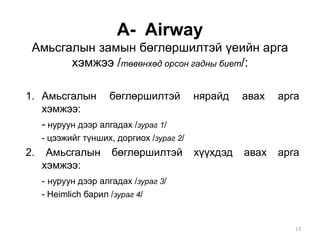A- Airway
Амьсгалын замын бөглөршилтэй үеийн арга
хэмжээ /төвөнхөд орсон гадны биет/:
1. Амьсгалын бөглөршилтэй нярайд авах арга
хэмжээ:
- нуруун дээр алгадах /зураг 1/
- цээжийг түнших, доргиох /зураг 2/
2. Амьсгалын бөглөршилтэй хүүхдэд авах арга
хэмжээ:
- нуруун дээр алгадах /зураг 3/
- Heimlich барил /зураг 4/
13
 