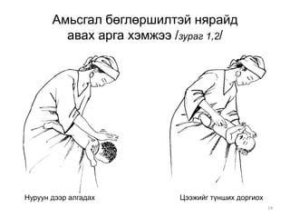 14
Амьсгал бөглөршилтэй нярайд
авах арга хэмжээ /зураг 1,2/
Нуруун дээр алгадах Цээжийг түнших доргиох
 