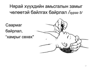 17
Нярай хүүхдийн амьсгалын замыг
чөлөөтэй байлгах байрлал /зураг 5/
Саармаг
байрлал,
“хамрыг сөхөх"
 