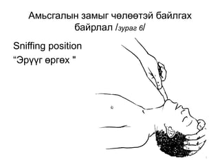 18
Амьсгалын замыг чөлөөтэй байлгах
байрлал /зураг 6/
Sniffing position
“Эрүүг өргөх "
 