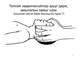 20
Толгойг хөдөлгөхгүйгээр эрүүг дарж,
амьсгалын замыг нээх
Хүзүүний гэмтэл байж болзошгүй /зураг 7/
 